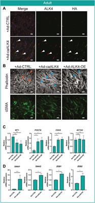 Activin A and ALK4 Identified as Novel Regulators of Epithelial to Mesenchymal Transition (EMT) in Human Epicardial Cells